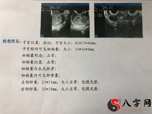 梦见自己怀孕做流产